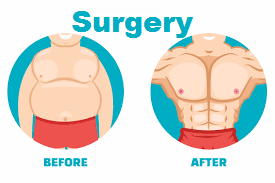 gynecomastia surgery